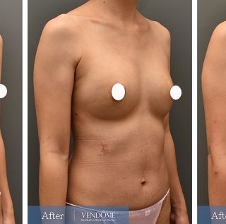 療程效果因人而異，上圖為A罩杯產後女性在做完自體脂肪隆乳之後​手術後一個月、手術後五個月成效